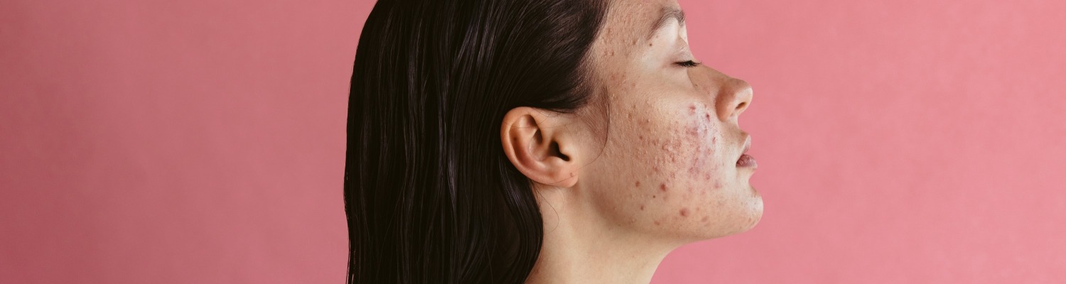 Dermal Fillers for Facial Scars