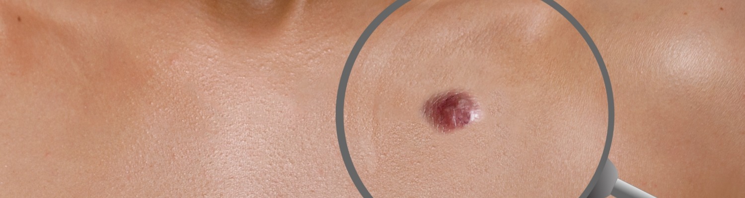 Fed up of Unsightly Skin Tags? Try Smartxide Dot