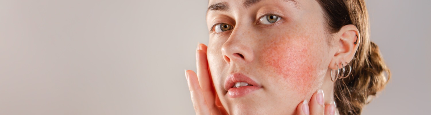 Rosacea Relief: Exploring Hydrafacial as a Treatment Option