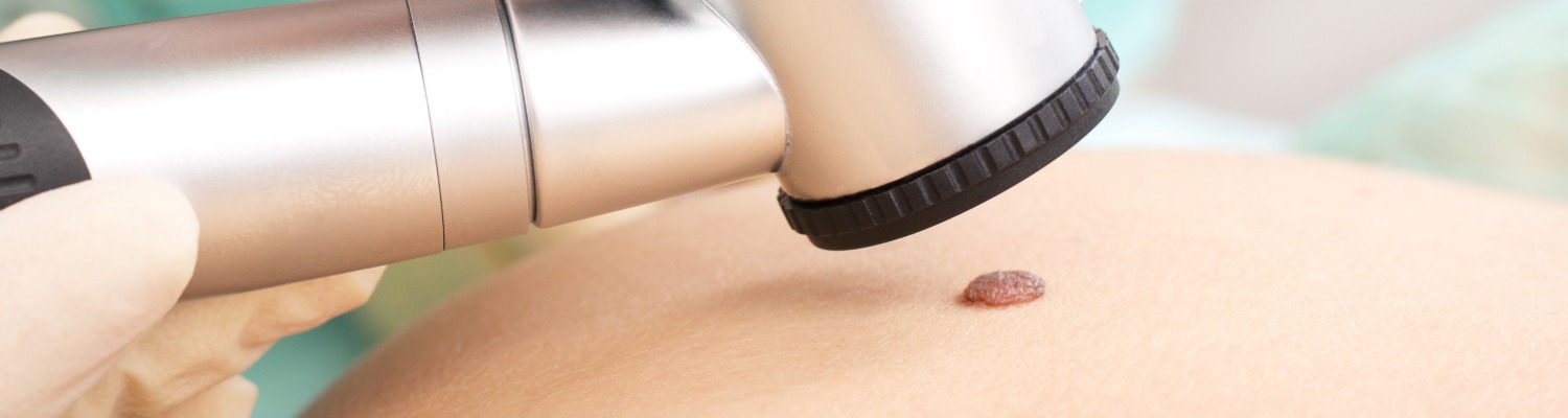 Everything You Need To Know About Moles and Mole Removal