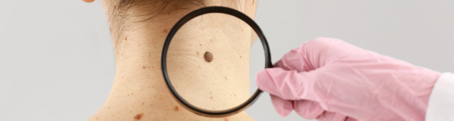 Everything You Need to Know About Mole Removal