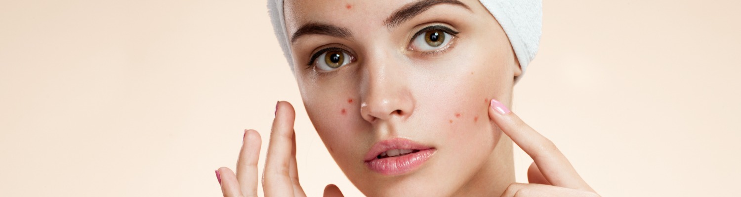 Psychological and Social Effects of Acne