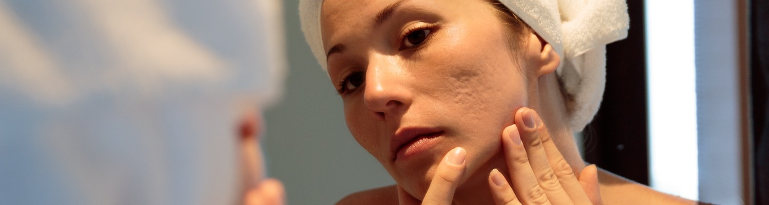 Say Goodbye to Acne Scars with Advanced Laser Treatments