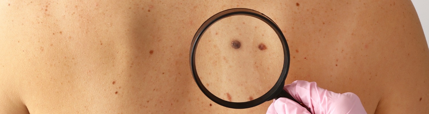 Skin Cancer Awareness Month: Life After Skin Cancer