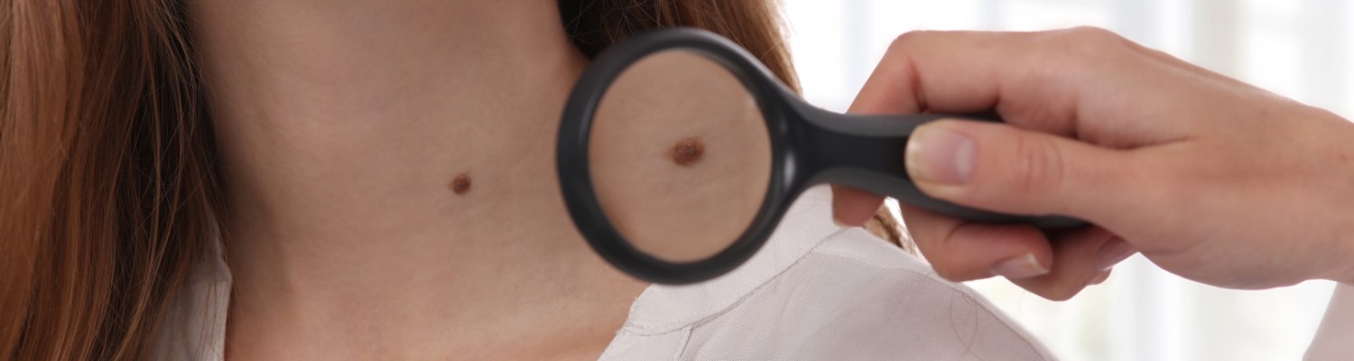 Everything You Need to Know About Skin Tags