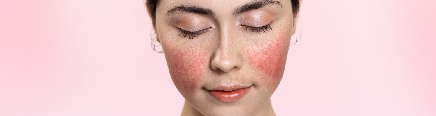Understanding Rosacea: Overview, Treatments, and Diagnosis