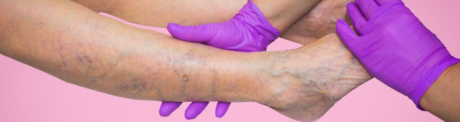 Are Varicose Veins Medical or Aesthetic? NHS or Private?