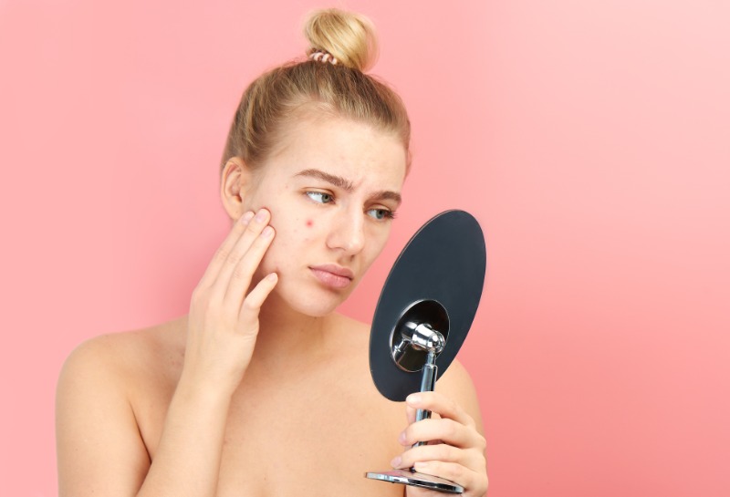 Acne Awareness Month: The Best Adult Acne Treatments