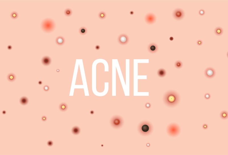 Acne Explained: Your No-Nonsense Guide to Everything Acne