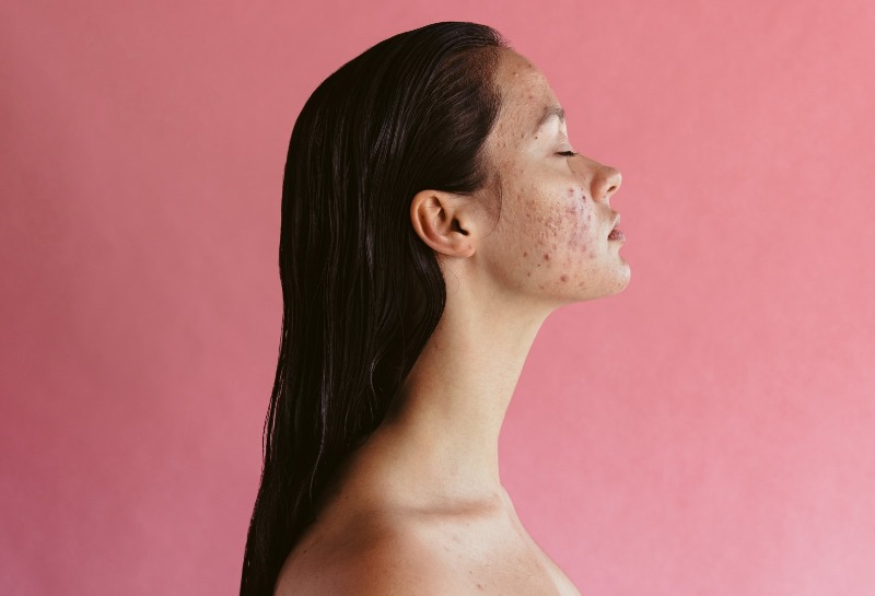 Are Hydrafacials Good for Acne?