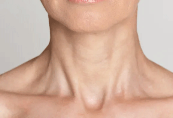 Exploring the Benefits of Botox for Neck Bands