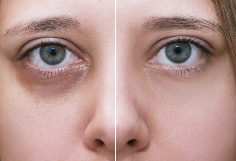 Dark Circles Under Eyes? Here’s How to Get Rid of Them...