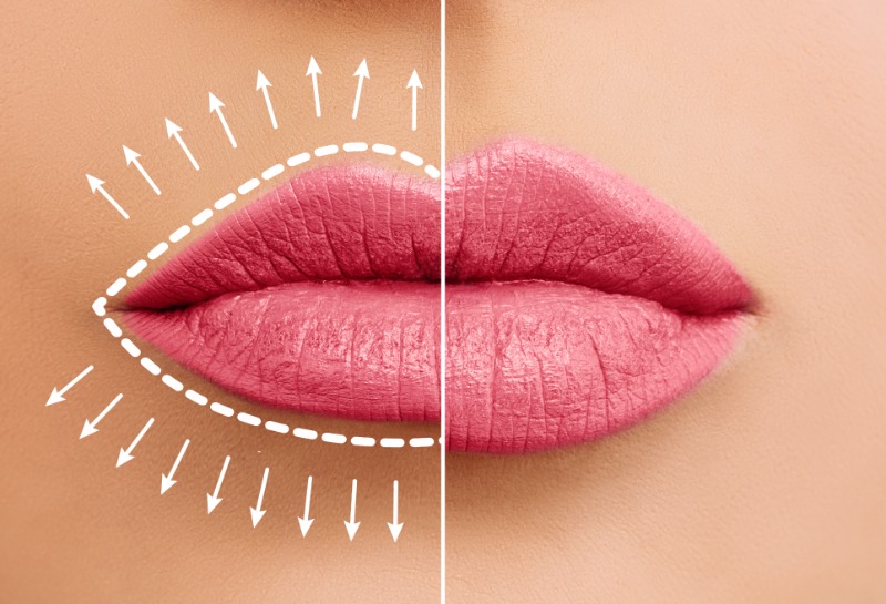 Dissolving Overfilled Lips: What an Expert Wants You to Know