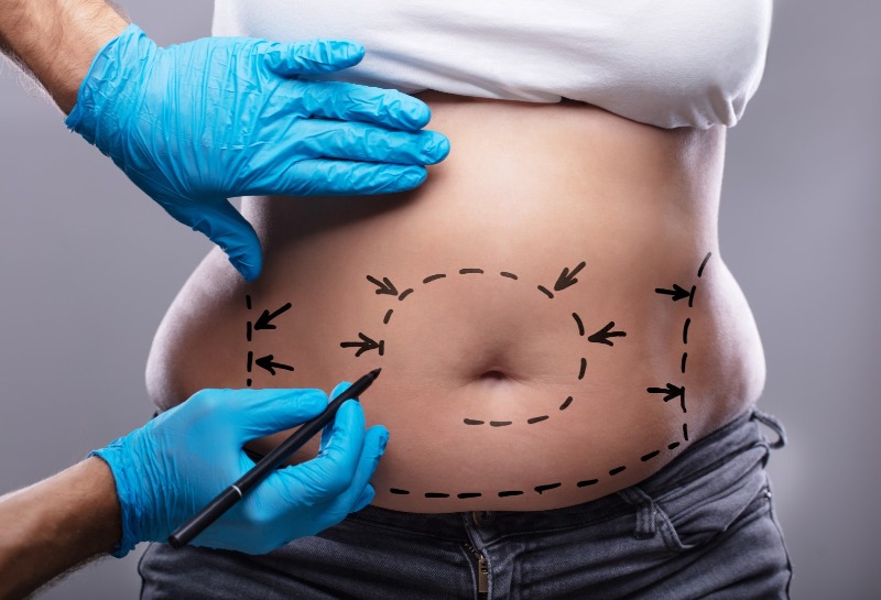 Does Liposuction Reduce the Risk of Heart Disease?