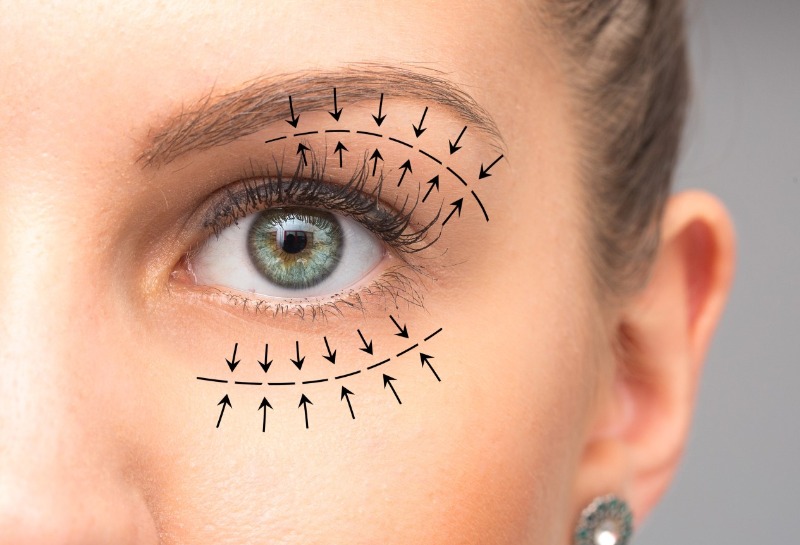 Eyelid Reduction Without Scars : Mini-Blepharoplasty