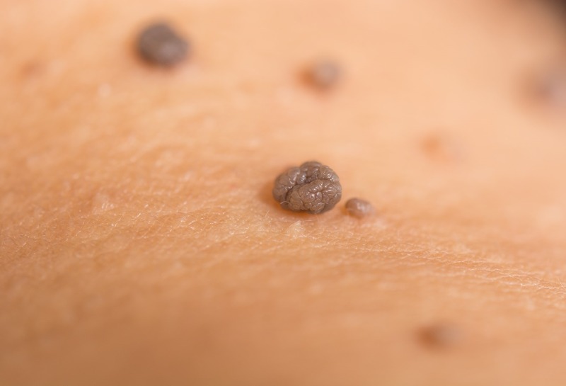 How to Get Rid of Cysts, Lumps, Bumps, Moles and Skin Tags