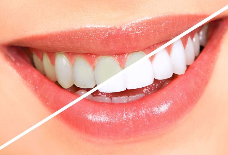 Illegal Tooth Whitening Crackdown by Government and Dentists