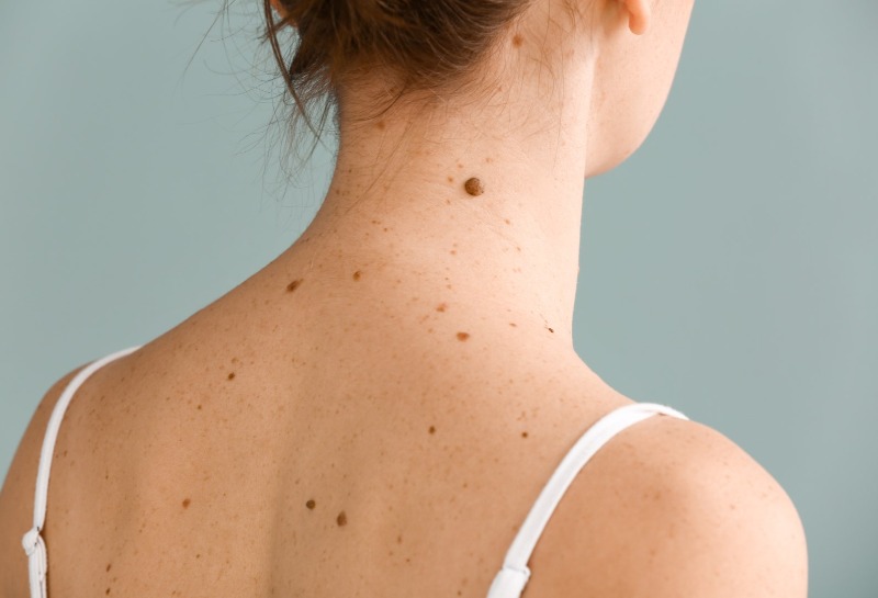 Everything You Need To Know About Moles and Mole Removal