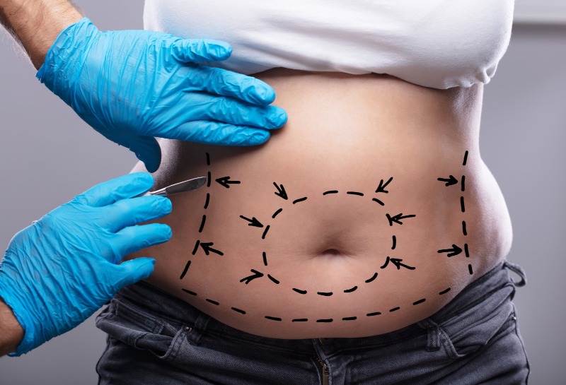 Lipoabdominoplasty My Way - The `Lock and Glue` Tummy Tuck