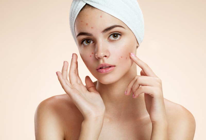 Psychological and Social Effects of Acne
