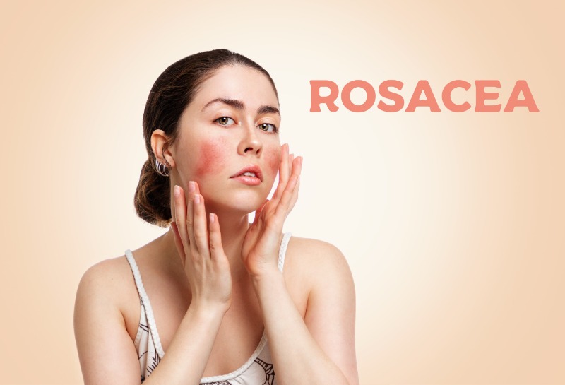 Say Goodbye to Rosacea Flare-Ups: Tried and Tested Solutions