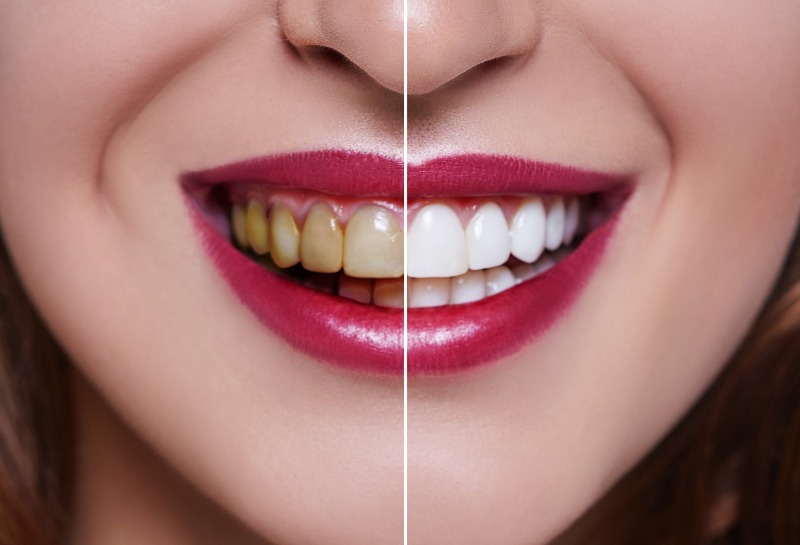 Should Teeth Whitening ONLY Be Performed by Dentists?