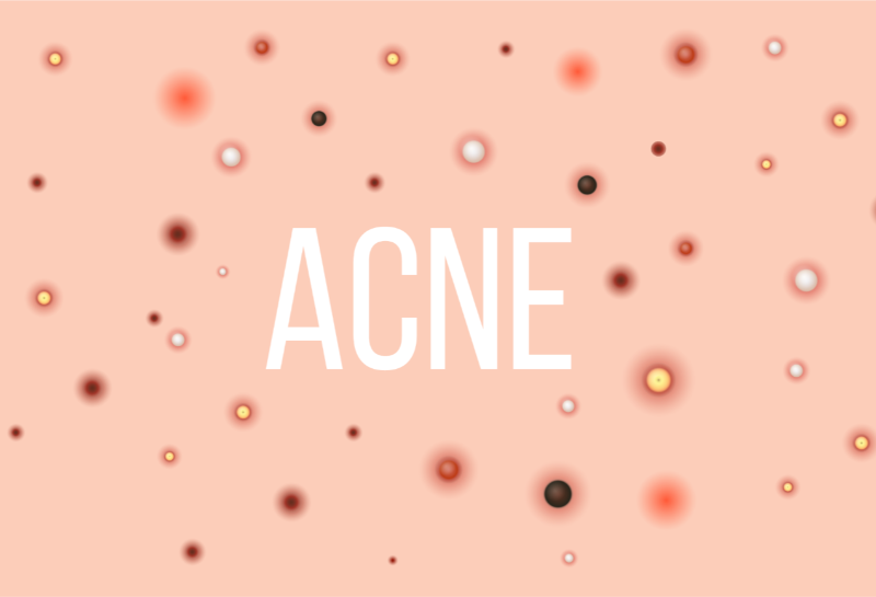 UK Acne in 2025: The Hidden Costs, the NHS Waiting Crisis, and the New Treatments Changing What's Possible