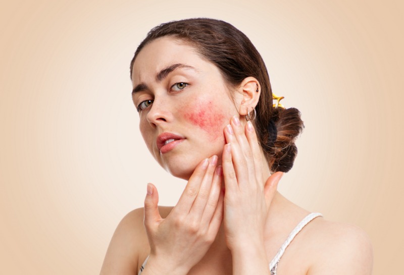 Understanding Rosacea: Overview, Treatments, and Diagnosis
