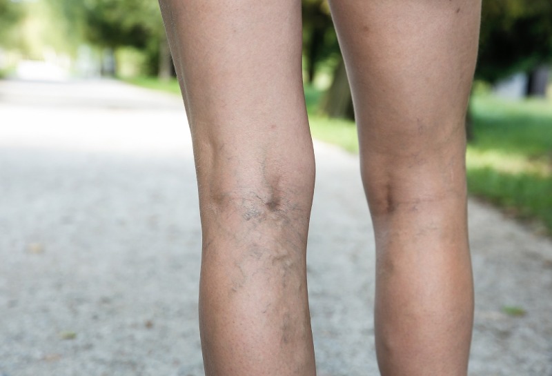 Your No-Nonsense Guide to Removing Thread Veins