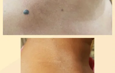Mole Removal Treatment Photo