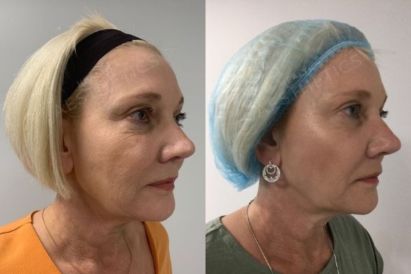 Before & After - Profhilo