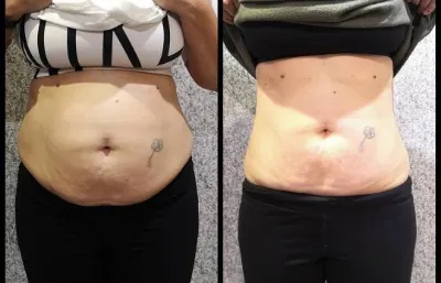 Before and after 3Dlipo fat freezing treatment Photo