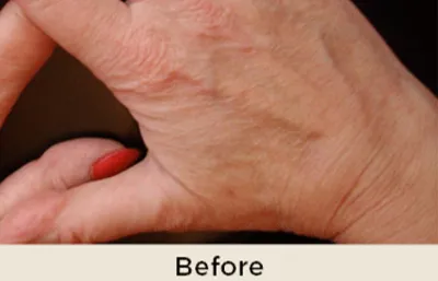 Before Hand Rejuvenation Treatment