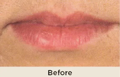 Before Lip Treatment Photo