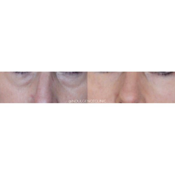 Tear Trough (uner eye) treatment using Teosyal