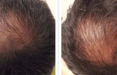 Before and after Hair loss treatment Photo