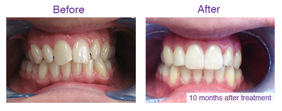 Invisalign Patient before & after completing treatment Photo