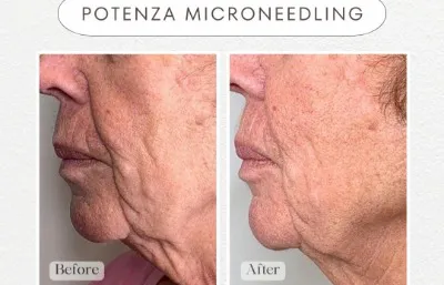 Before and after Micro-needling treatment Photo