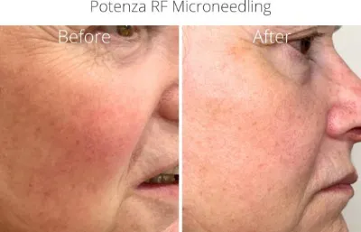 Before and after Potenza RF microneedling treatment Photo