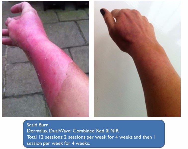 Scald Burn Before and After