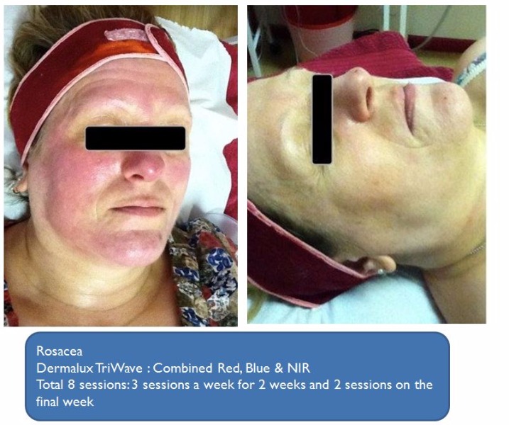 Rosacea Before and After