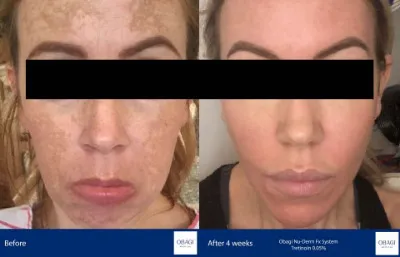 Before and after Obagi Nu-Derm Photo