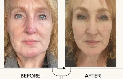 Before and after skin rejuvenation treatment Photo