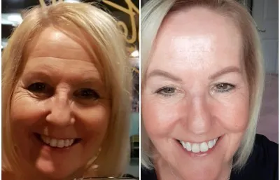 Before and after Lines and wrinkles treatment
