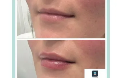 Before and after lip Filler treatment