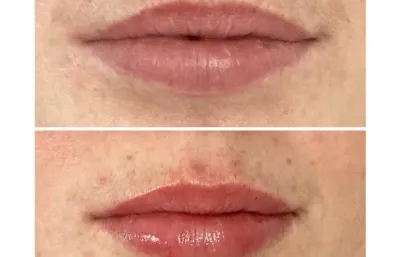 Before and after lip volumising treatment 