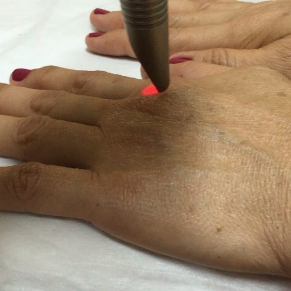 Hand rejuvenation