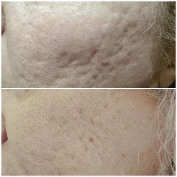 Acne scar laser treatment