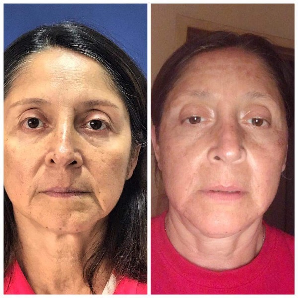 Before and After pictures of 4D laser facelift