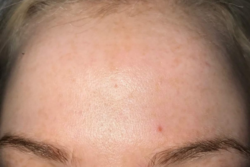 Pigmented skin lesions on forehead